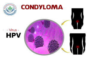 Condyloma là gì? Biểu hiện bệnh và cách chữa trị